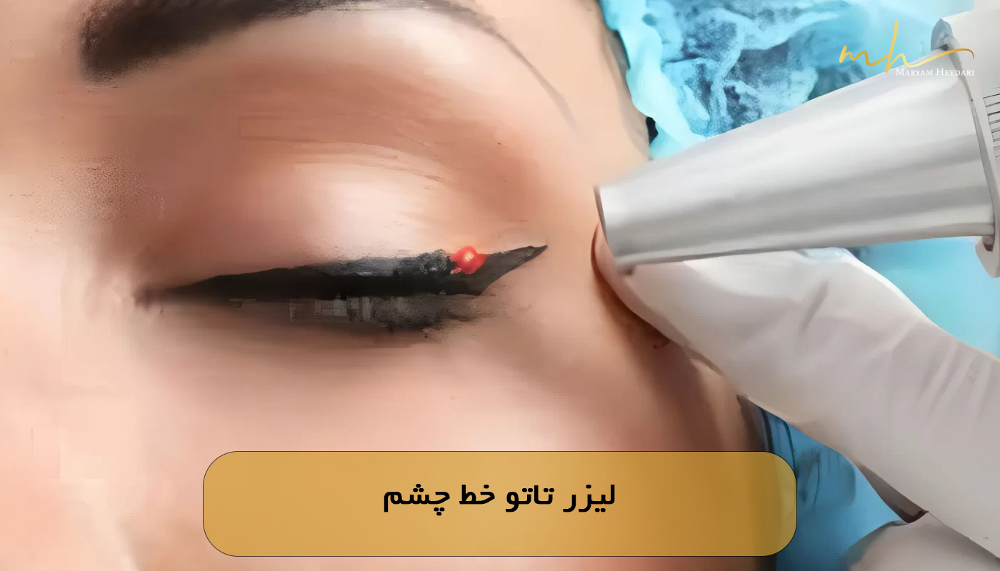 لیزر تاتو خط چشم