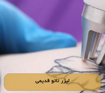 لیزر تاتو قدیمی
