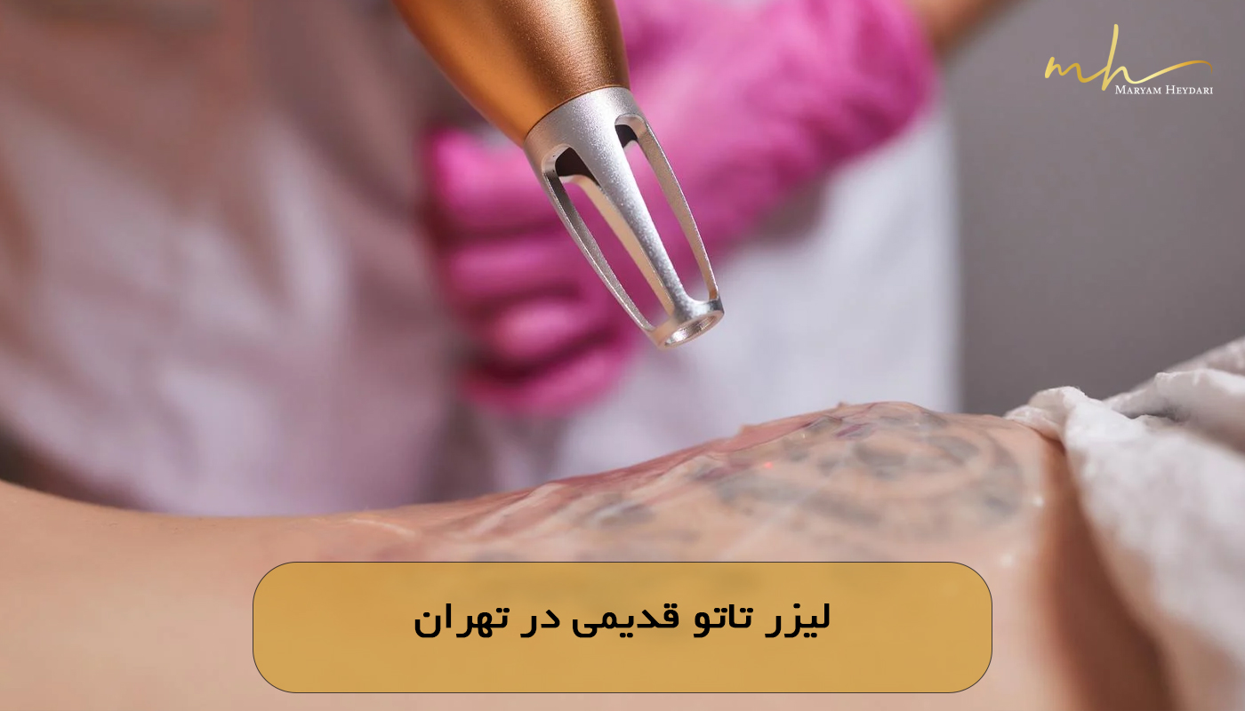 لیزر تاتو قدیمی در تهران
