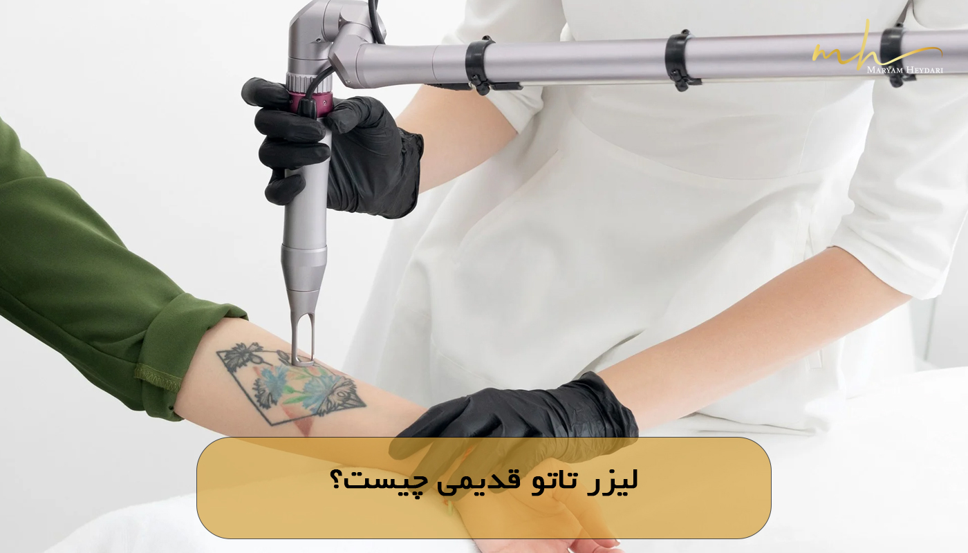 لیزر تاتو قدیمی چیست؟