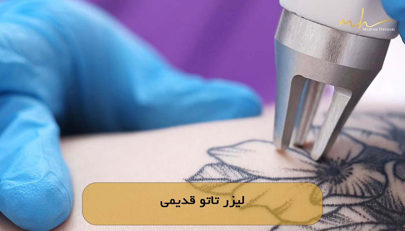 لیزر تاتو قدیمی