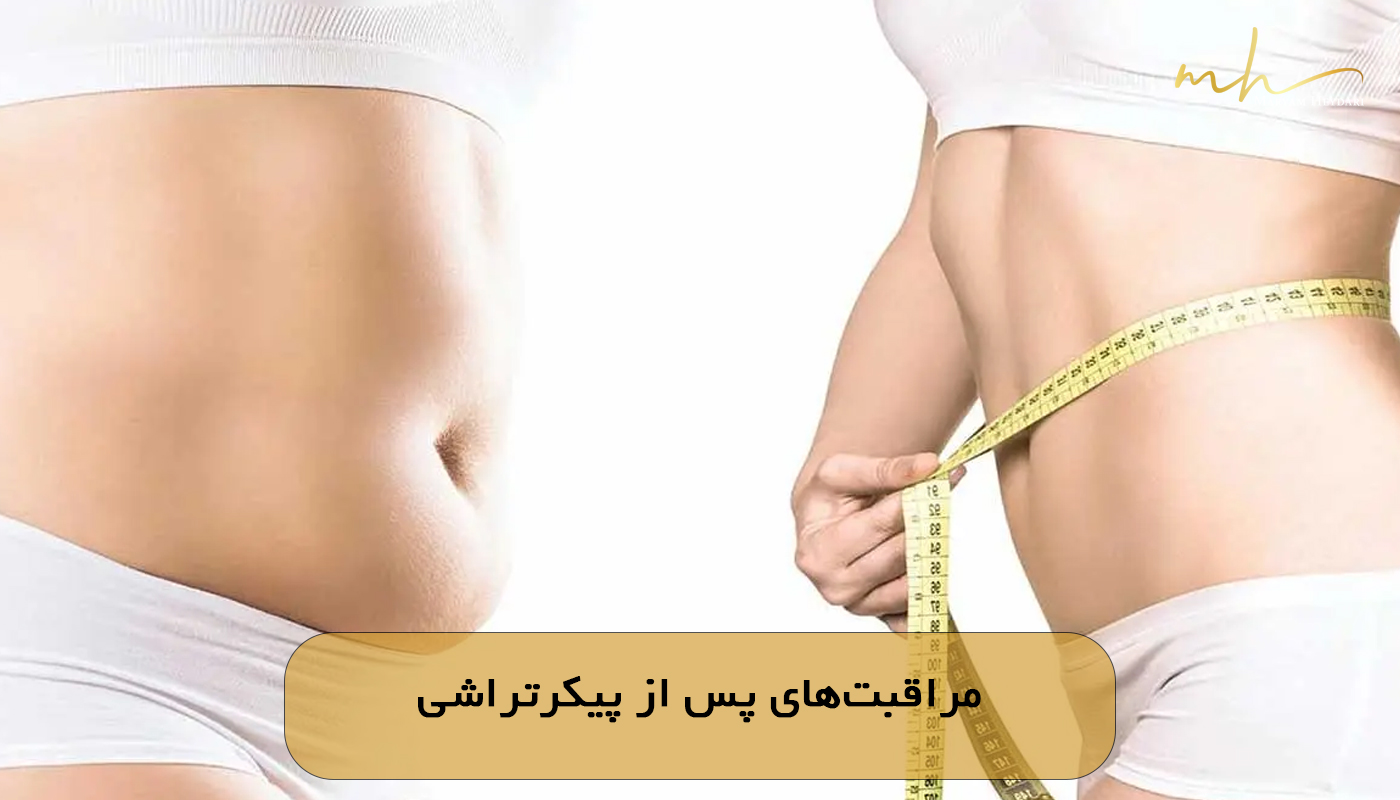 مراقبت‌های پس از پیکرتراشی