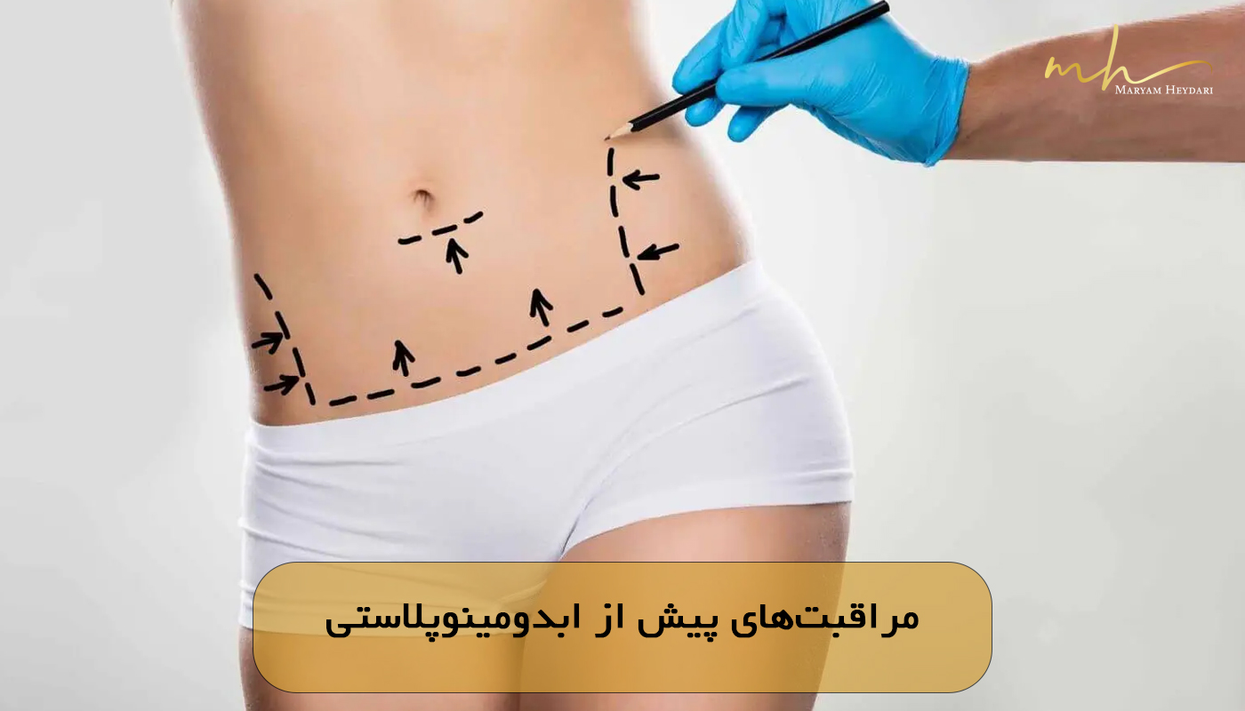 مراقبت‌های پیش از ابدومینوپلاستی