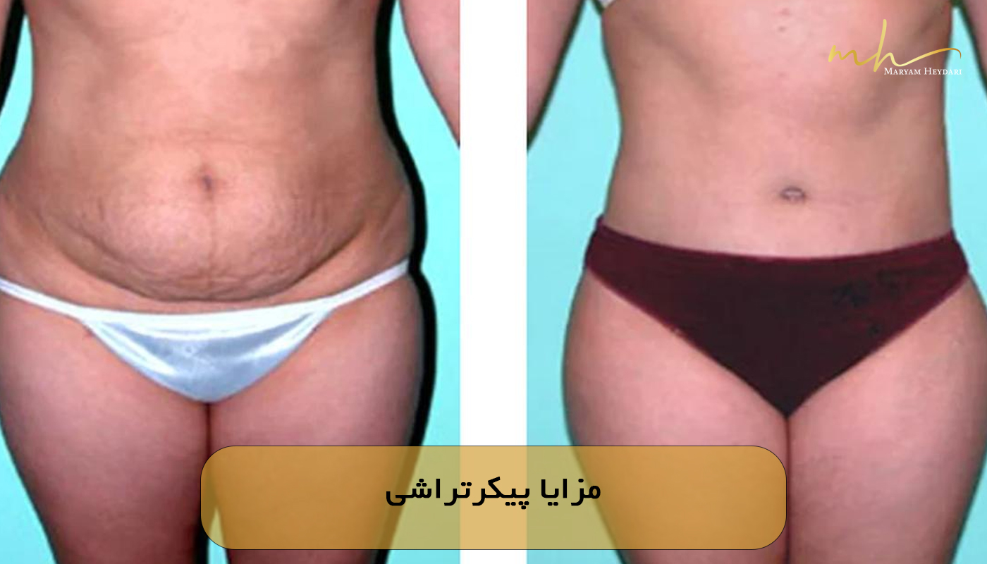 مزایا پیکرتراشی