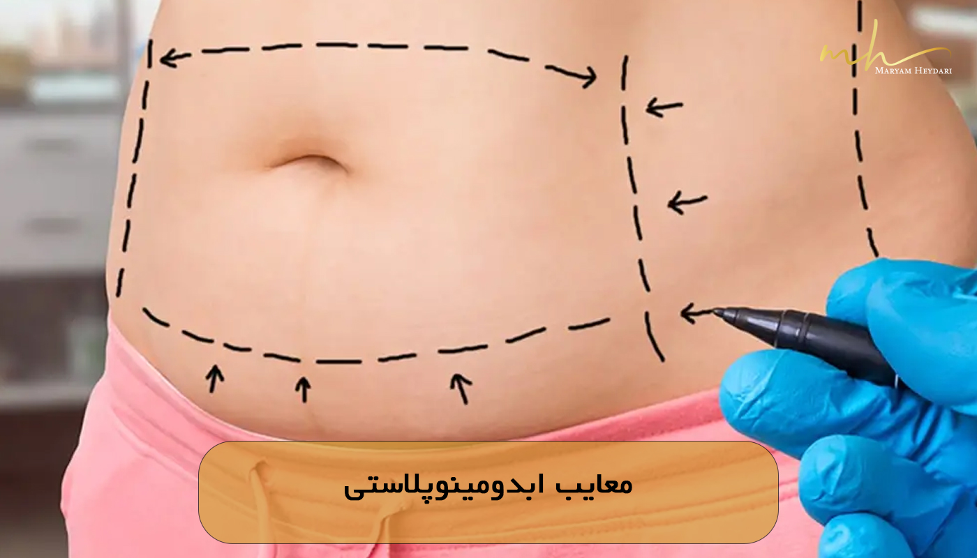 معایب ابدومینوپلاستی