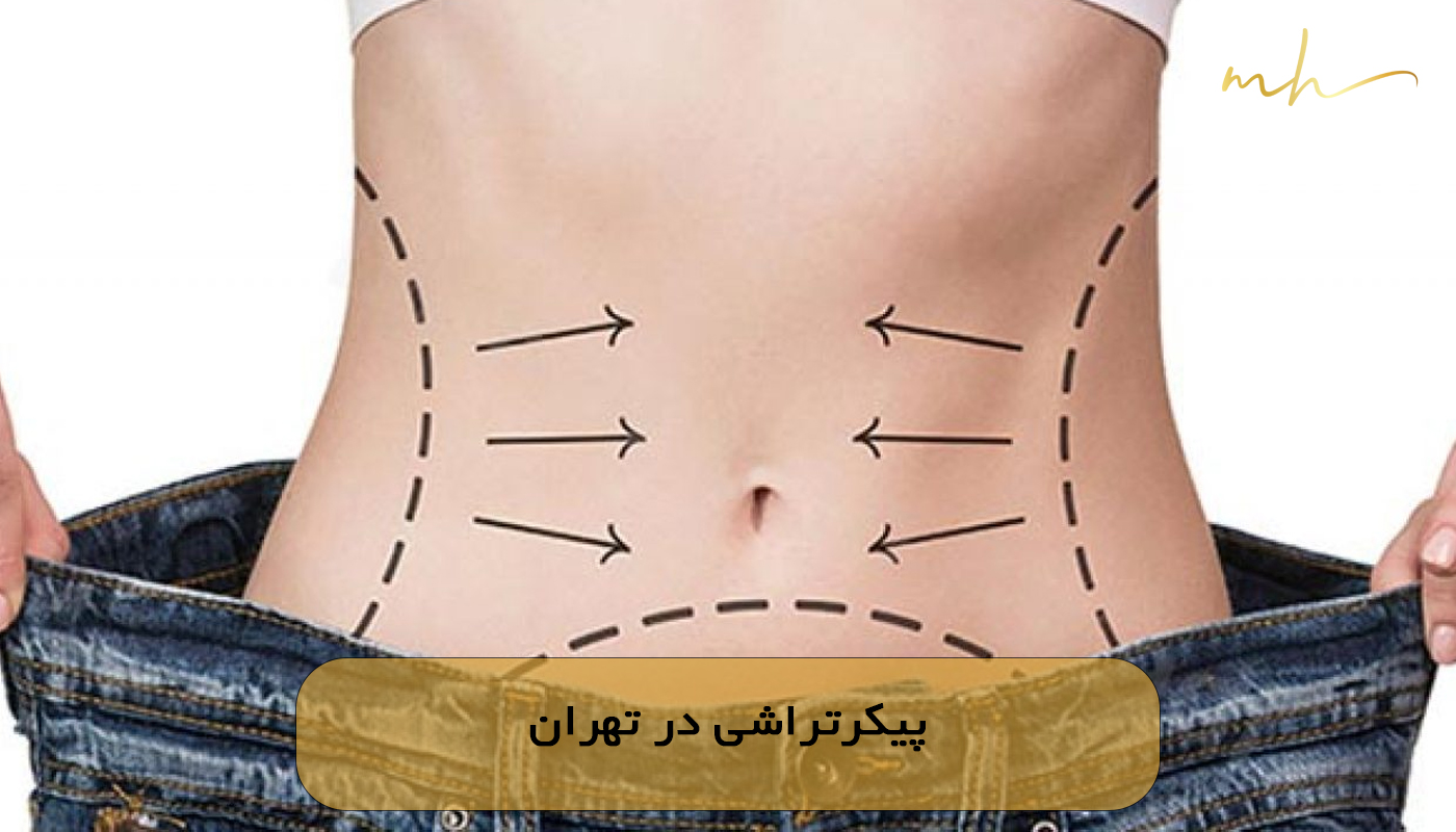 پیکرتراشی در تهران
