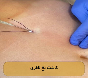 کاشت نخ لاغری