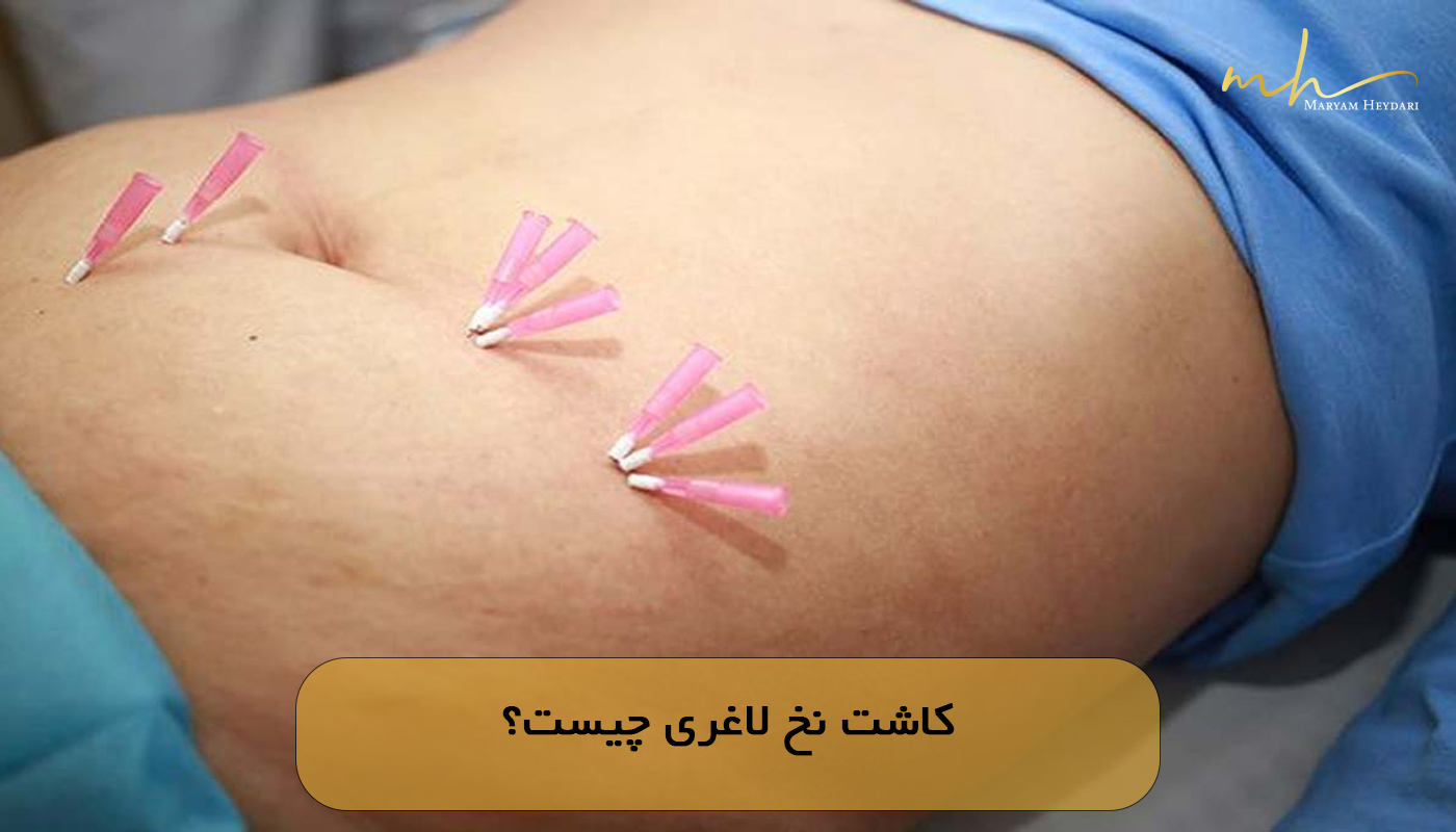 کاشت نخ لاغری چیست؟