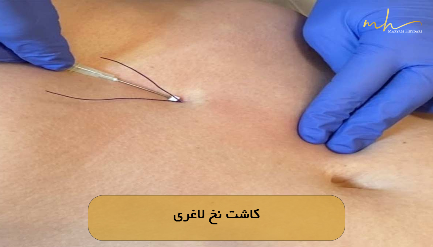 کاشت نخ لاغری