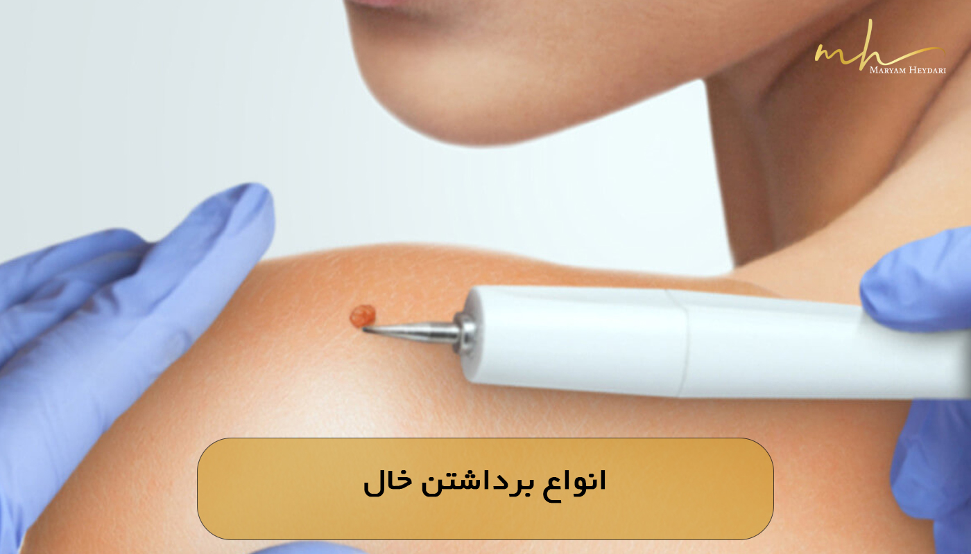 انواع برداشتن خال