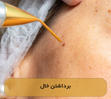 برداشتن خال