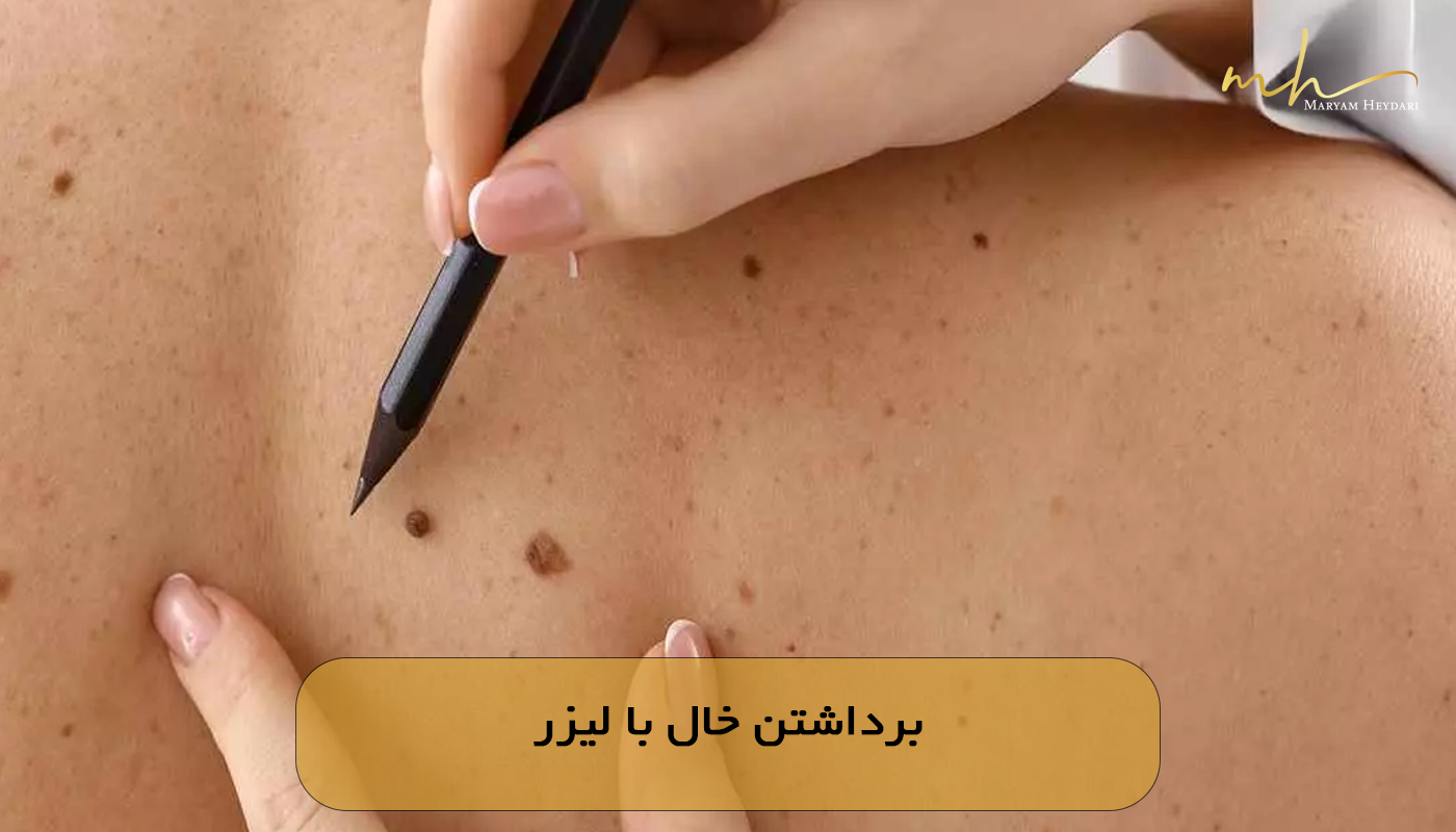 برداشتن خال با لیزر