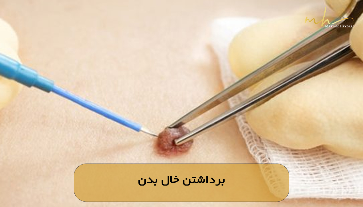برداشتن خال بدن