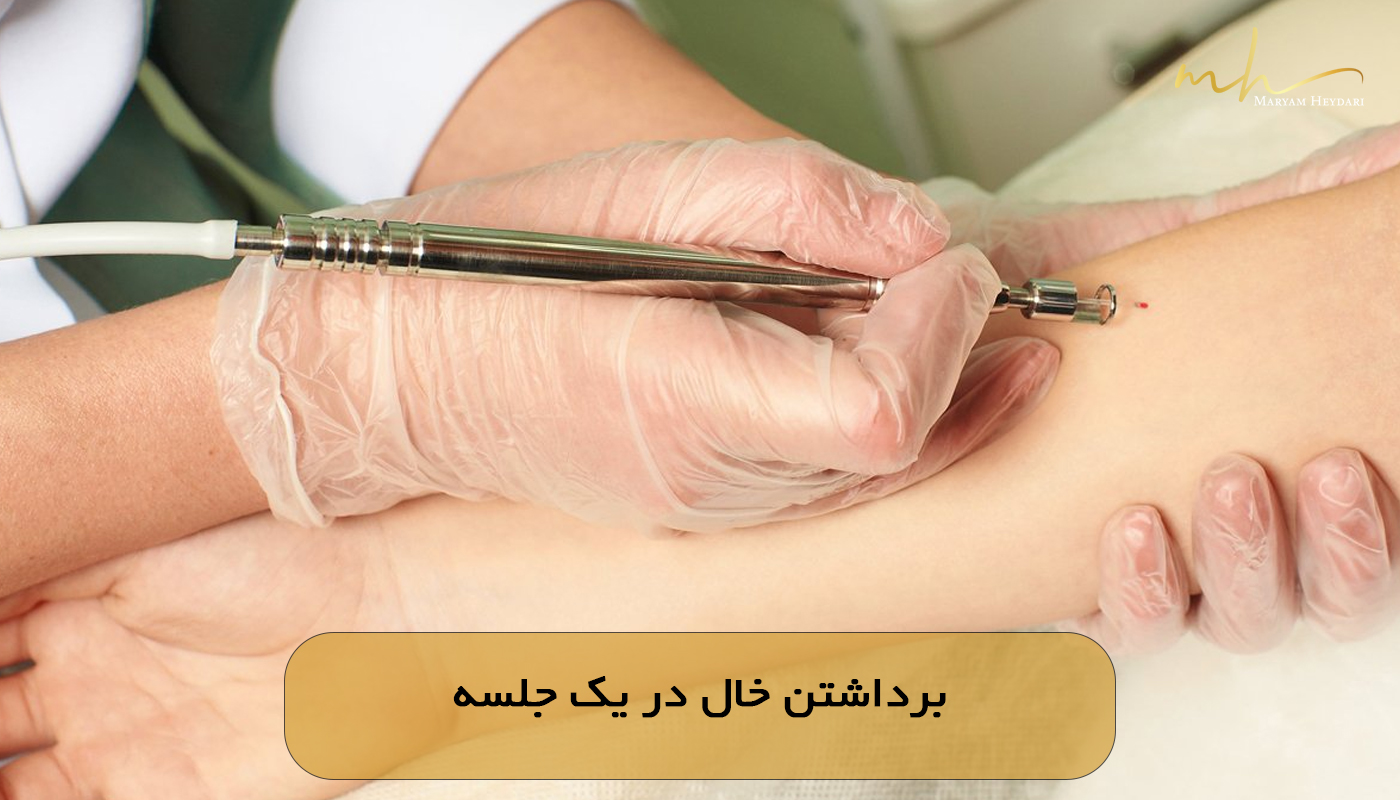 برداشتن خال در یک جلسه