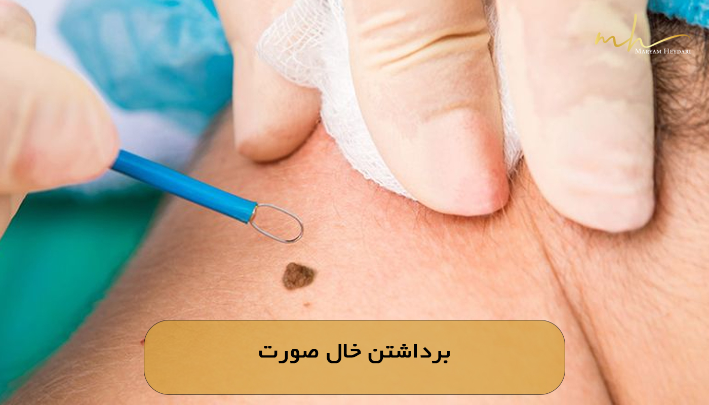 برداشتن خال صورت