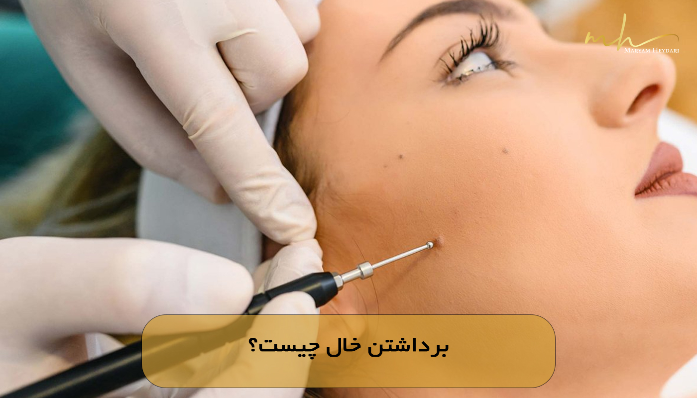برداشتن خال چیست؟