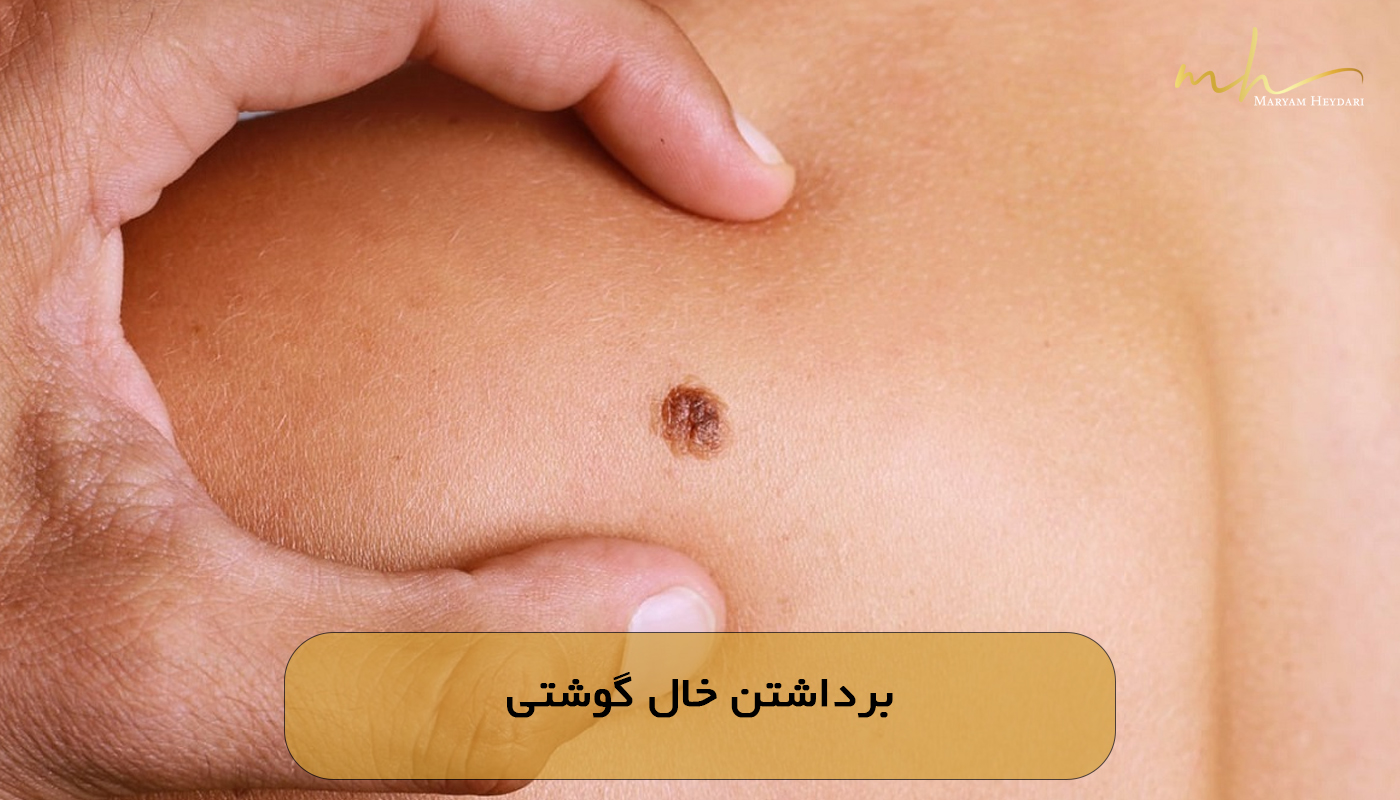 برداشتن خال گوشتی