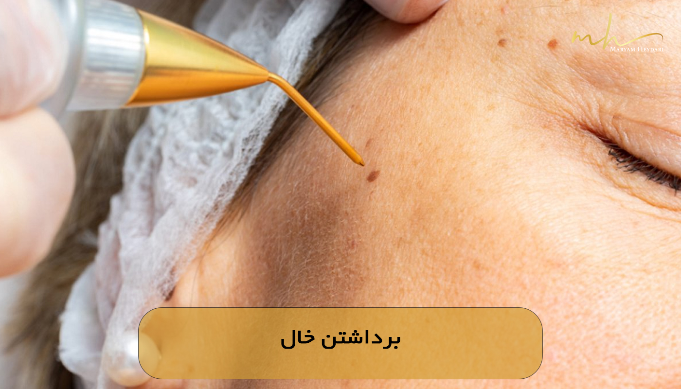 برداشتن خال