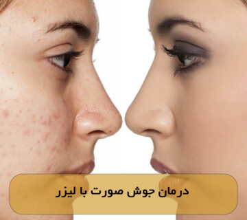 درمان جوش صورت با لیزر