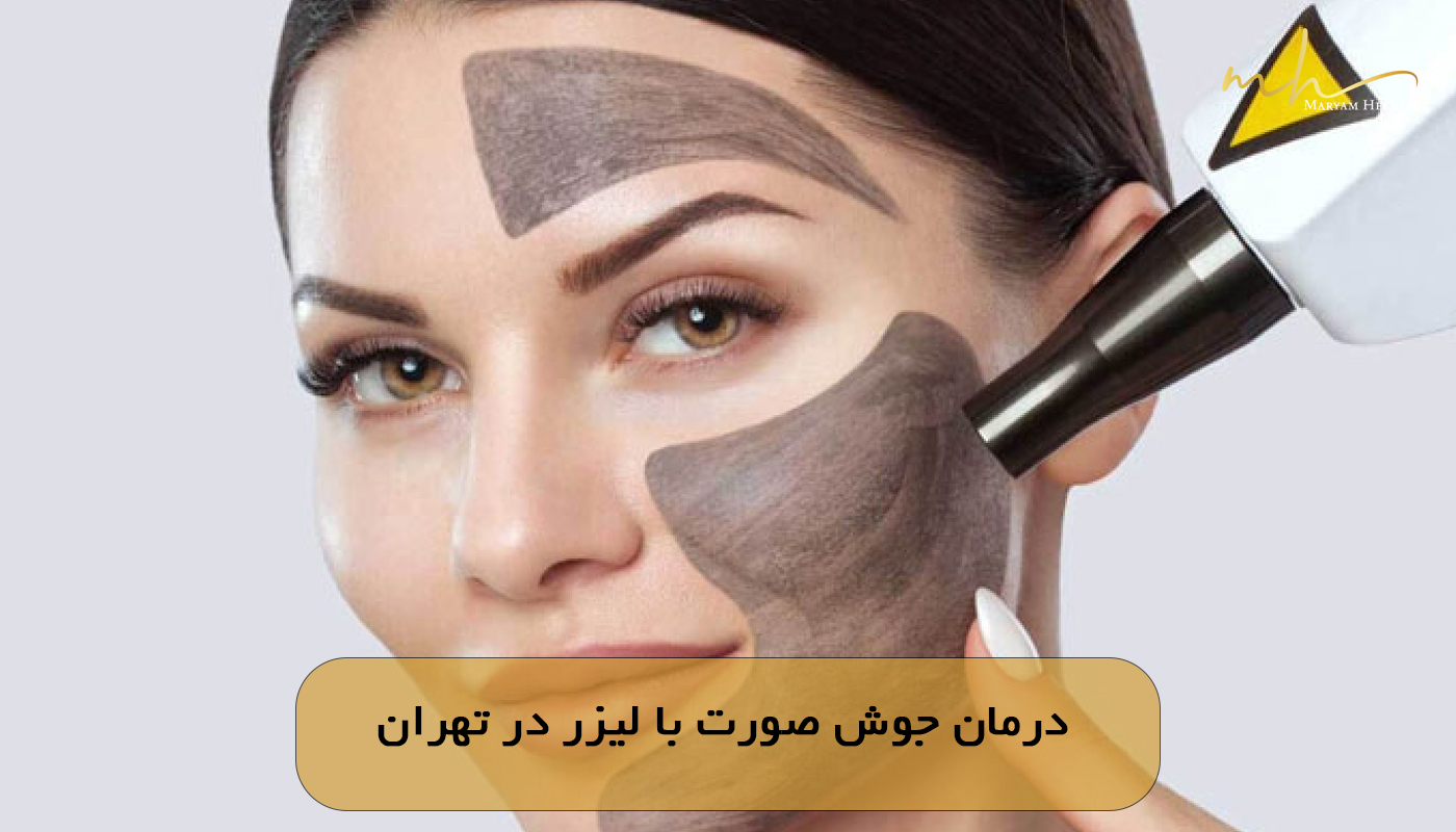 درمان جوش صورت با لیزر در تهران