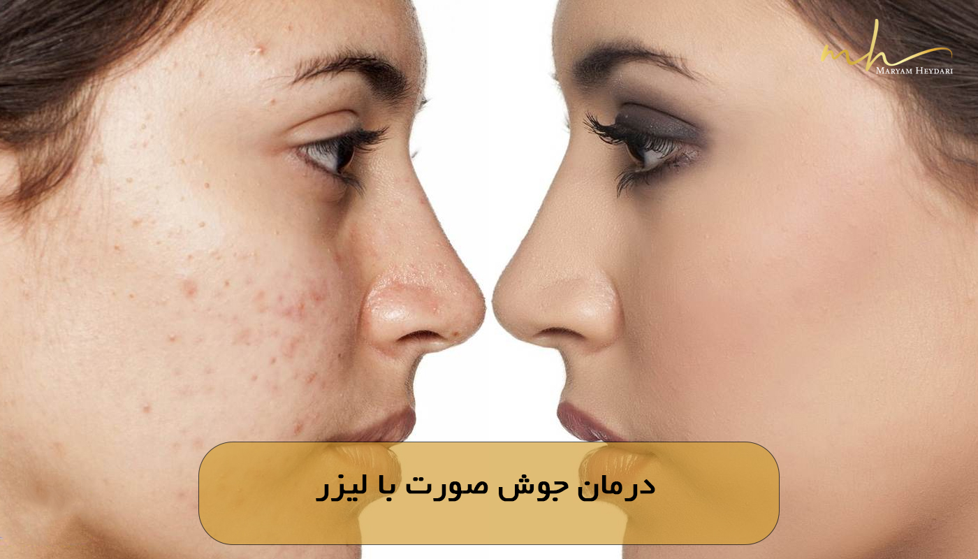 درمان جوش صورت با لیزر