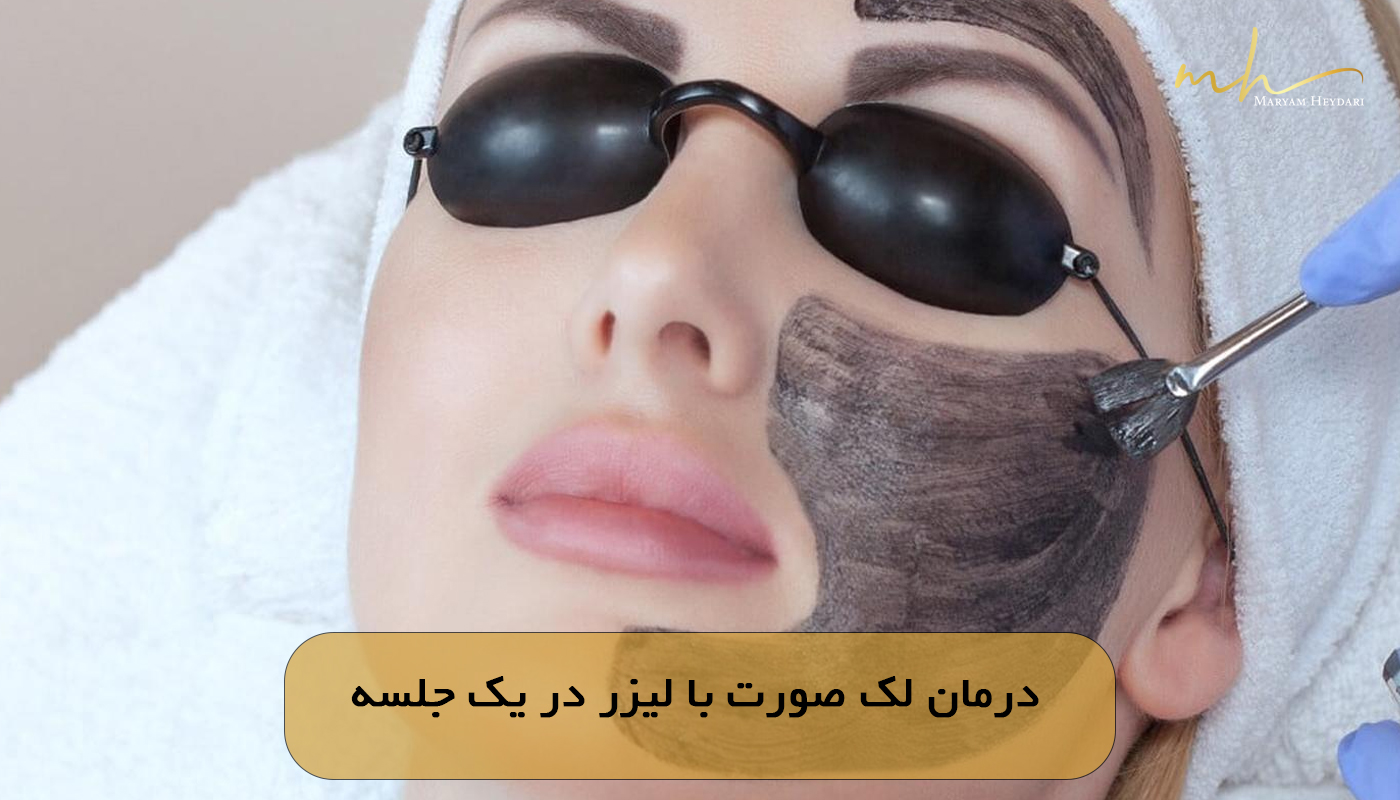 درمان لک صورت با لیزر در یک جلسه