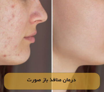 درمان منافذ باز صورت