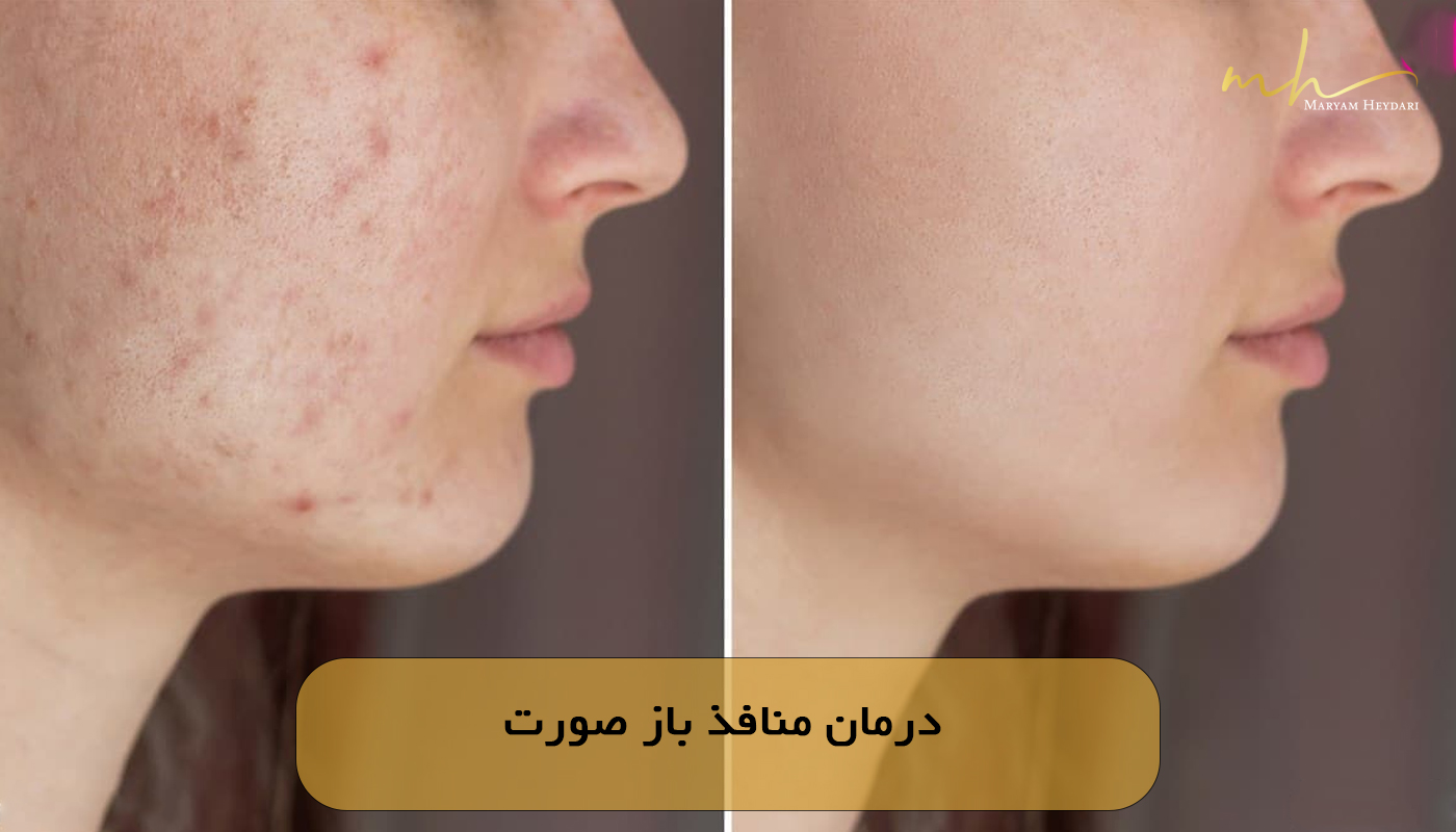 درمان منافذ باز صورت