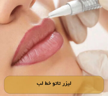 لیزر تاتو خط لب