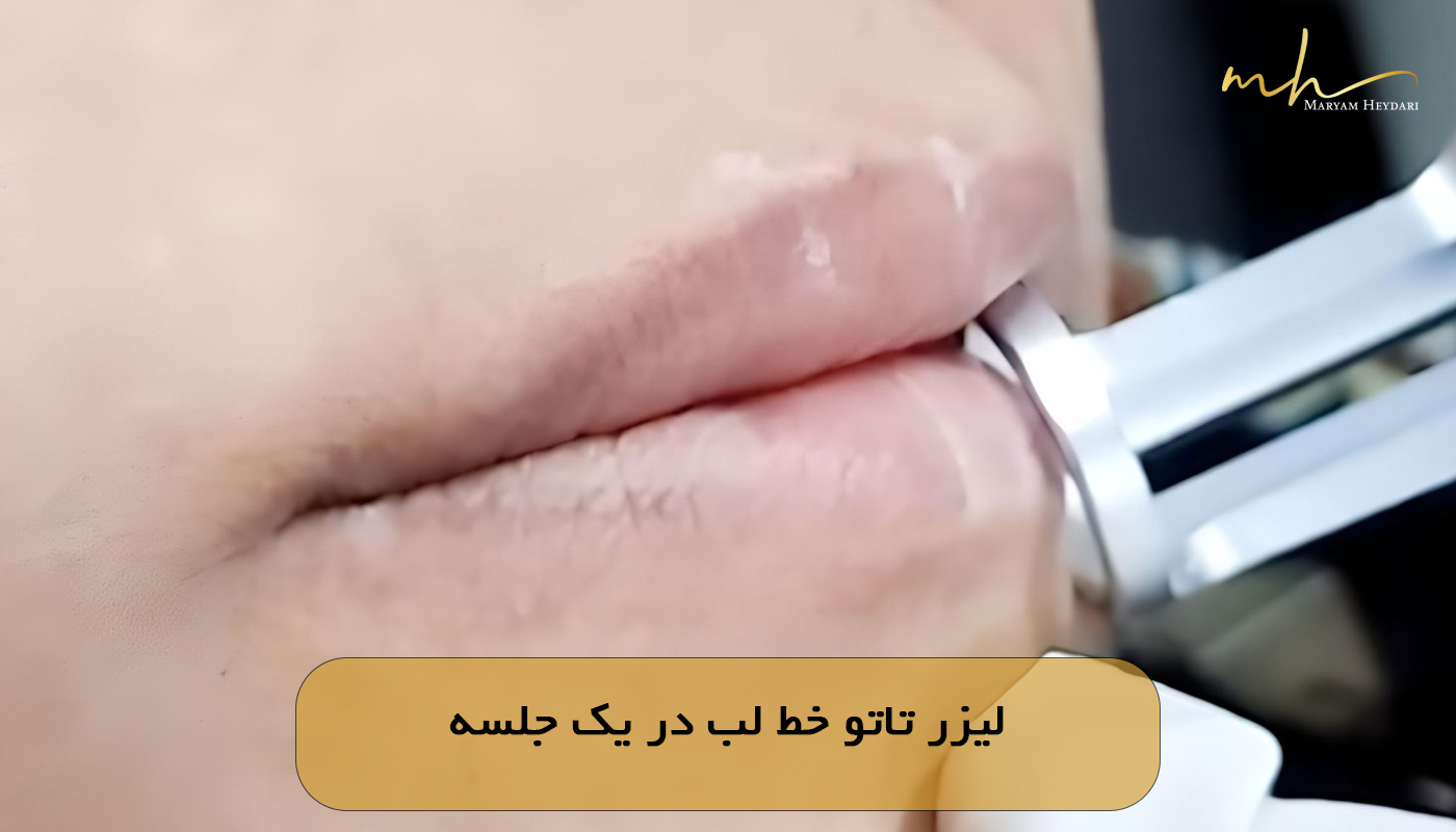 لیزر تاتو خط لب در یک جلسه