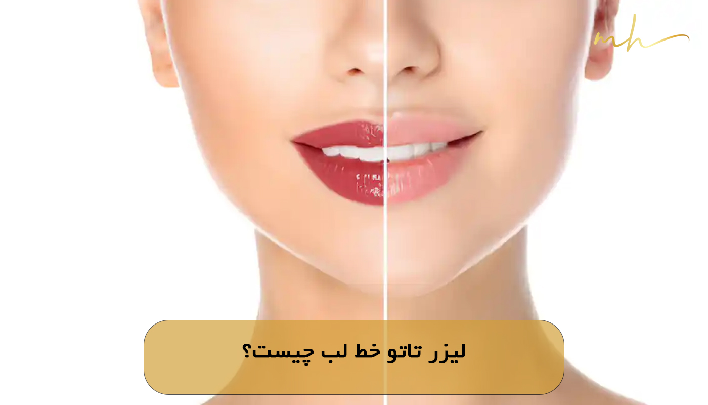 لیزر تاتو خط لب چیست؟