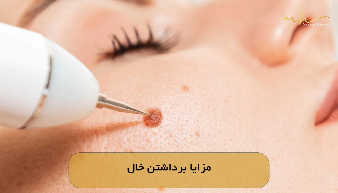 مزایا برداشتن خال