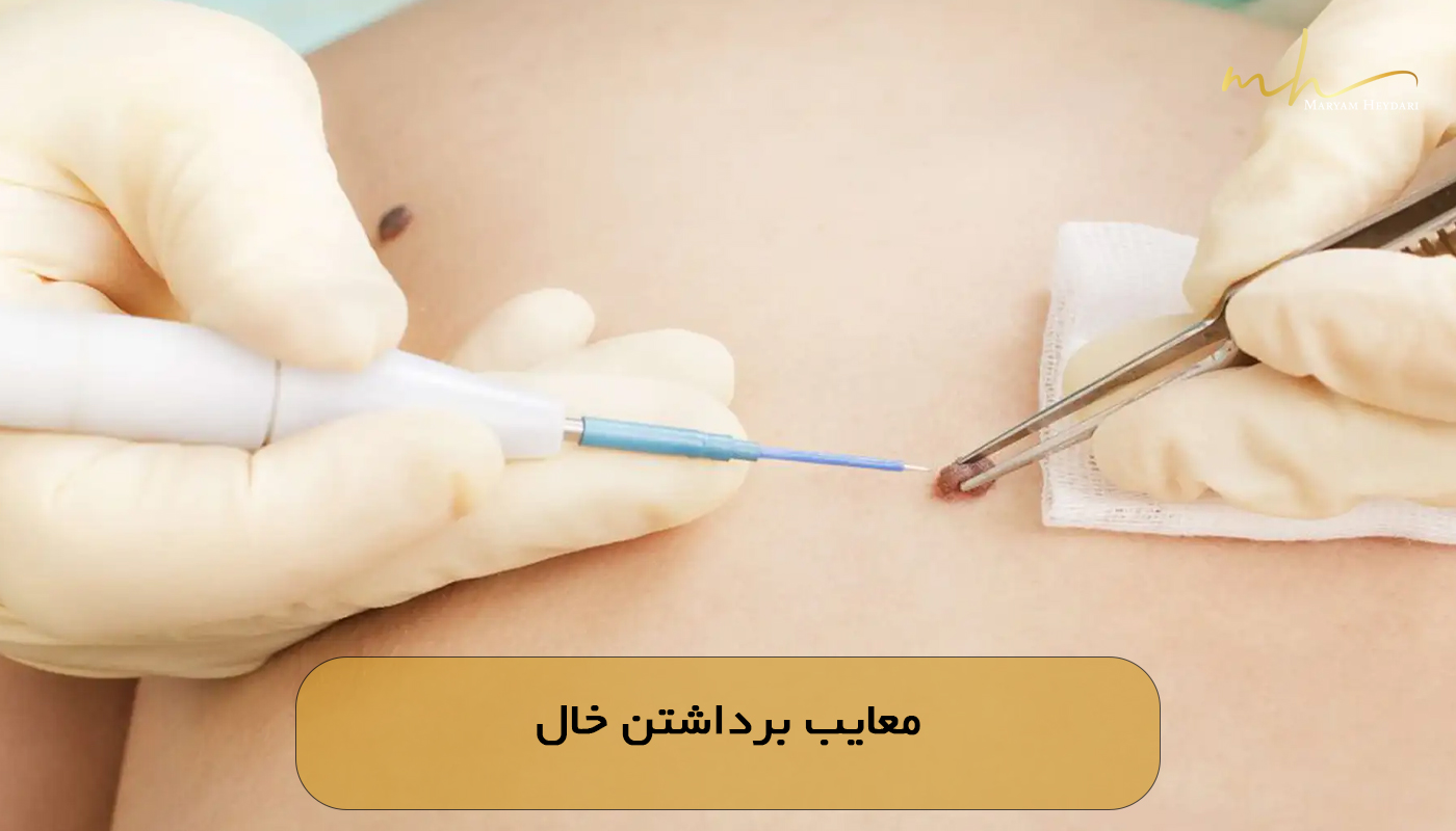 معایب برداشتن خال