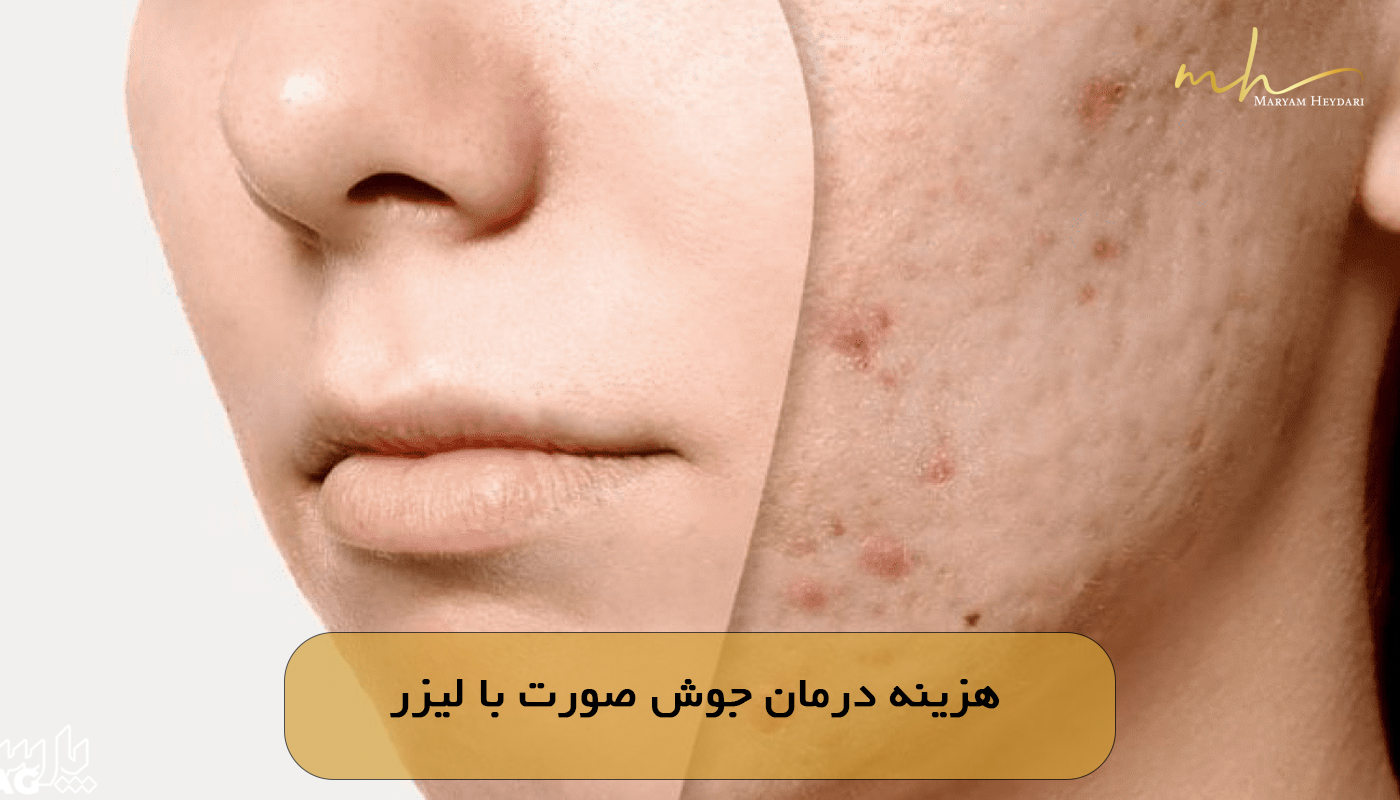 هزینه درمان جوش صورت با لیزر
