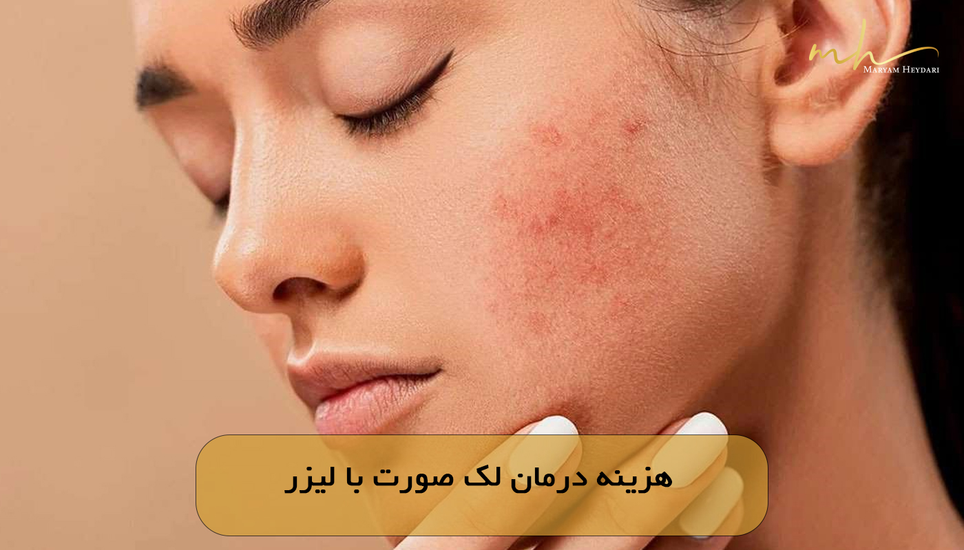 هزینه درمان لک صورت با لیزر