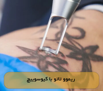 ریموو تاتو با کیوسوییچ