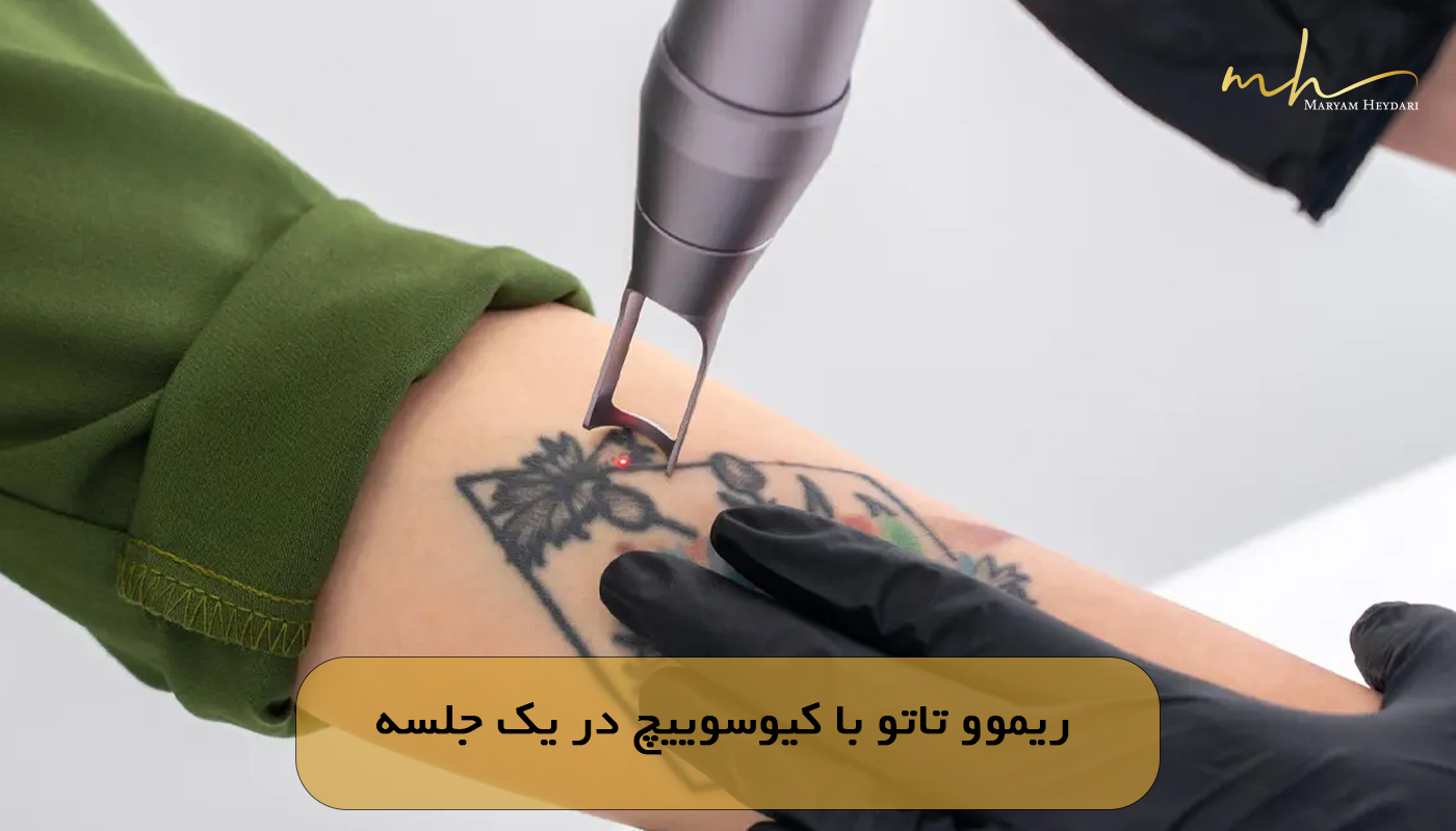 ریموو تاتو با کیوسوییچ در یک جلسه