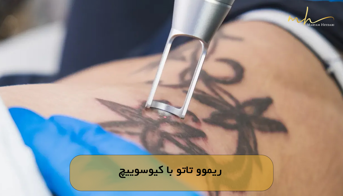 ریموو تاتو با کیوسوییچ