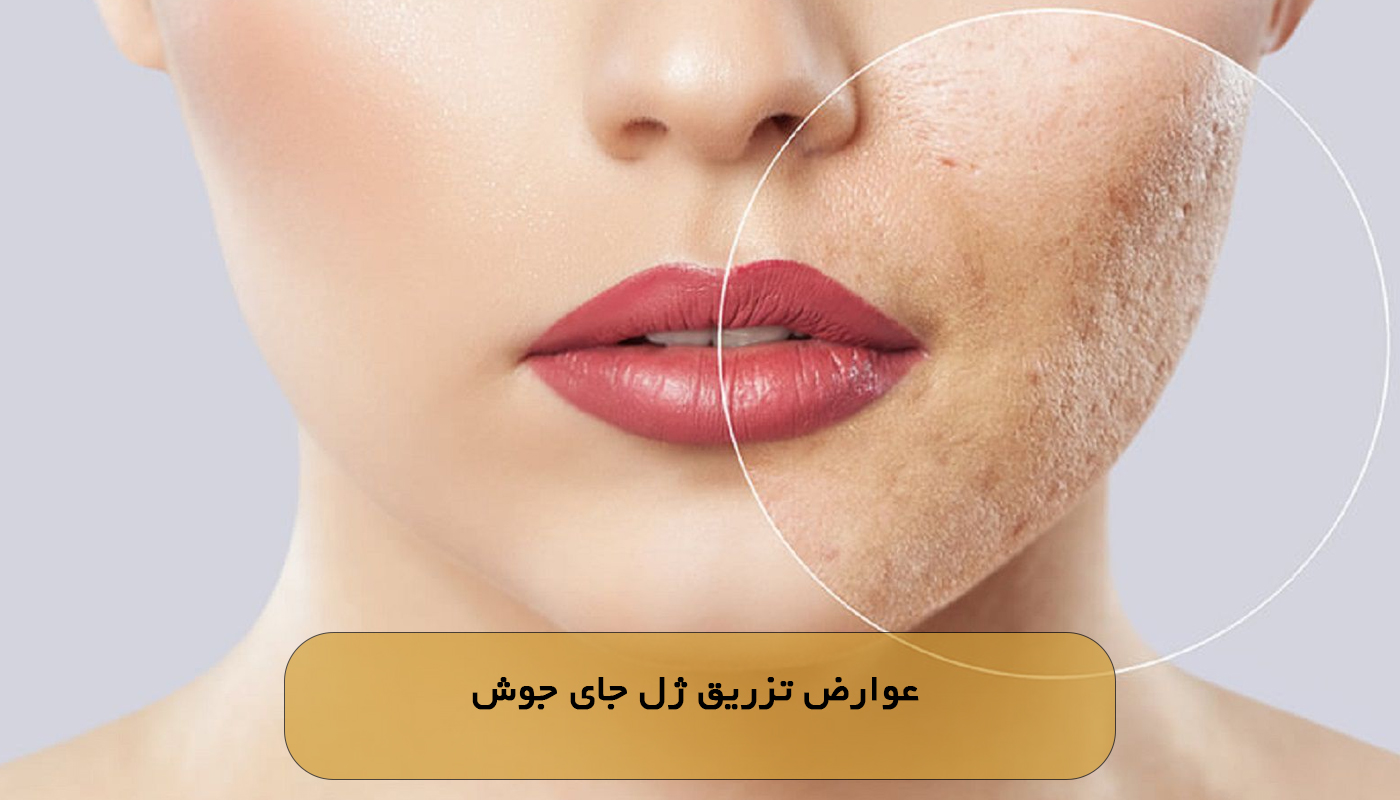 عوارض تزریق ژل جای جوش
