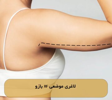 لاغری موضعی RF بازو