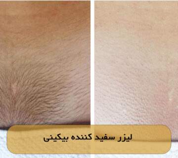 لیزر سفید کننده بیکینی