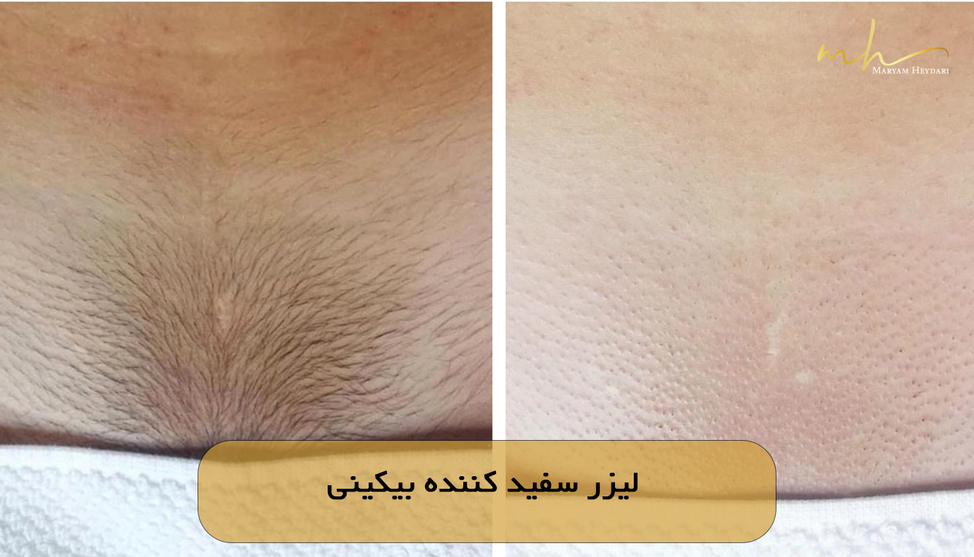 لیزر سفید کننده بیکینی