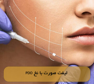 لیفت صورت با نخ PDO