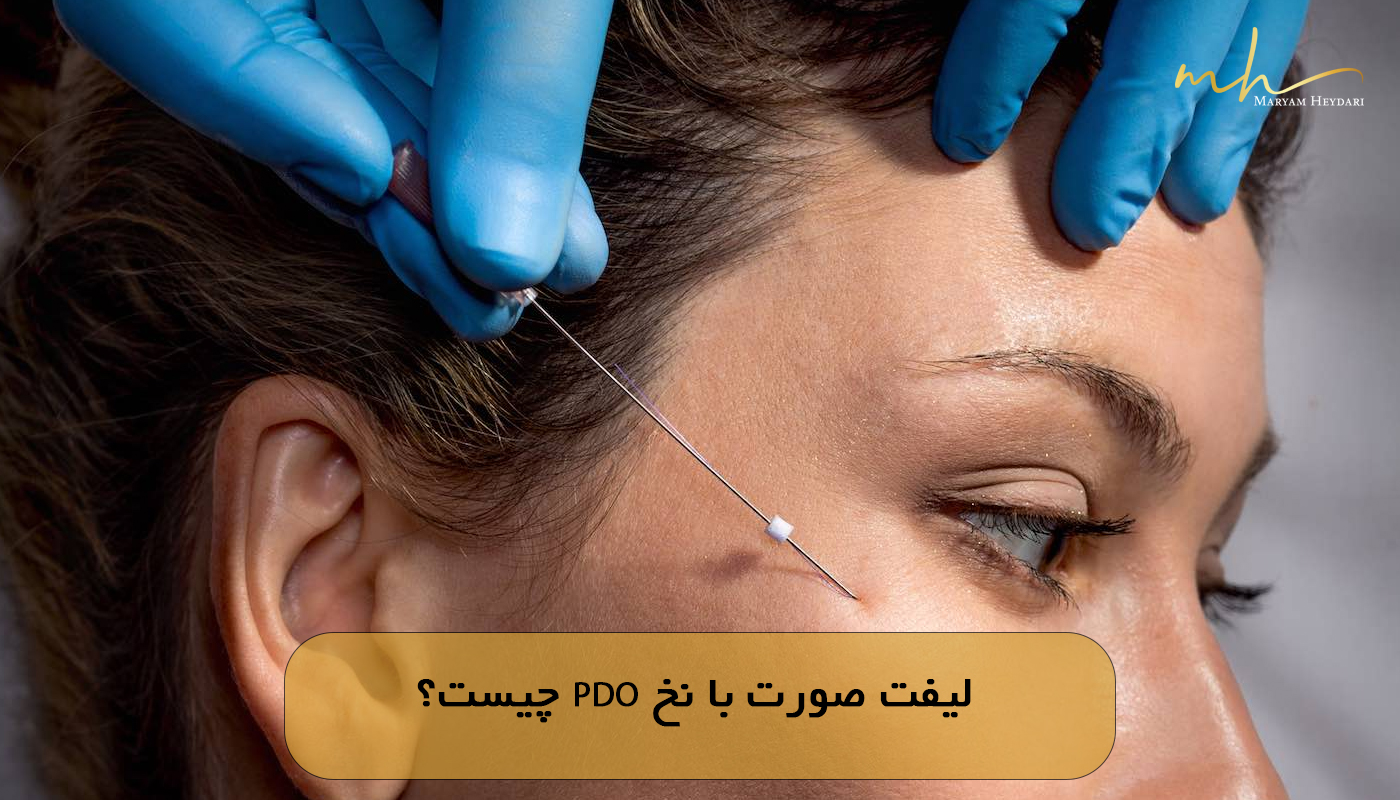لیفت صورت با نخ PDO چیست؟