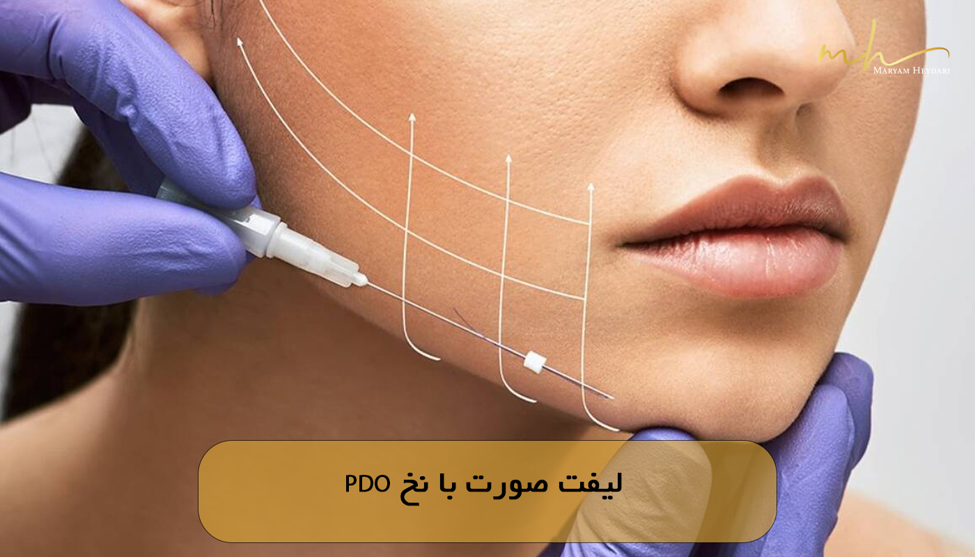 لیفت صورت با نخ PDO