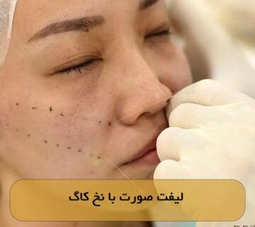 لیفت صورت با نخ کاگ