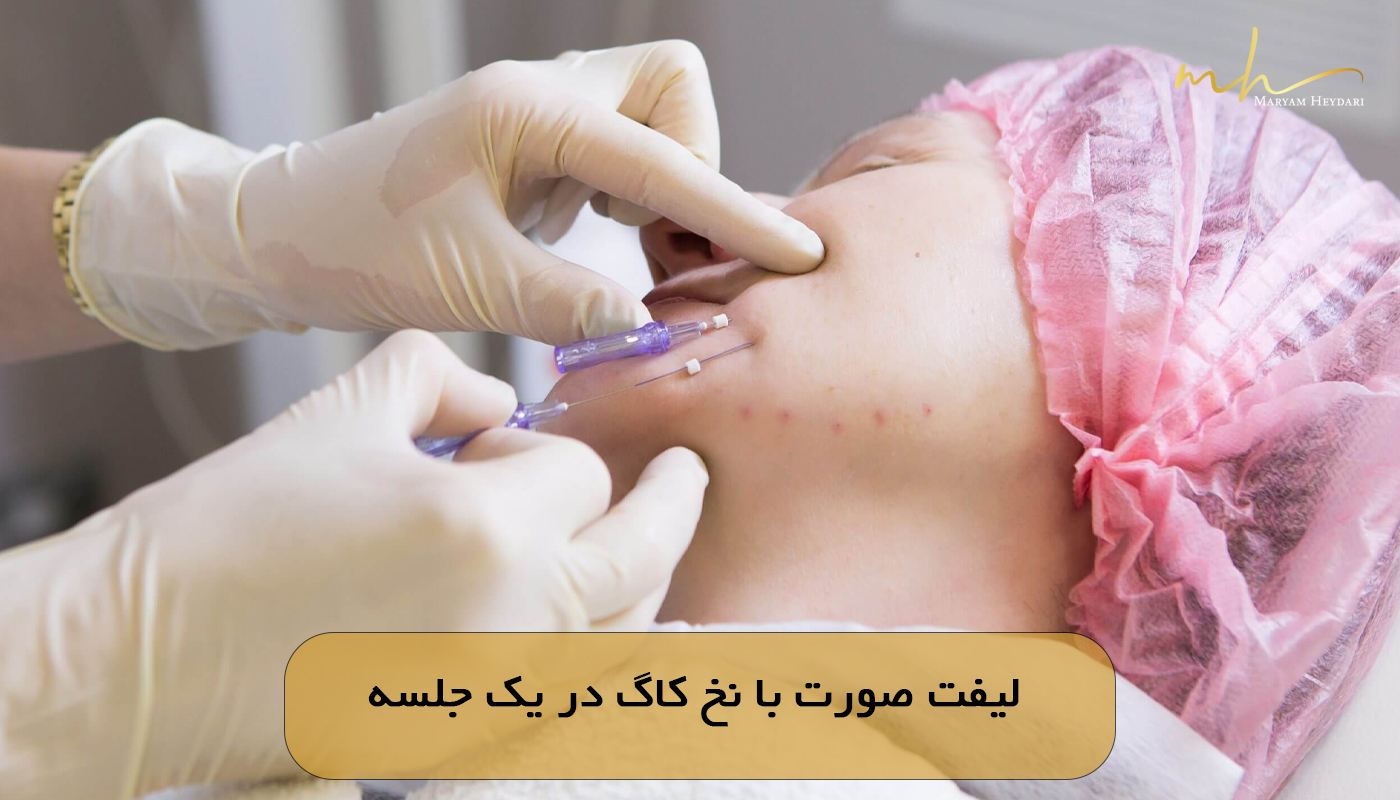 لیفت صورت با نخ کاگ در یک جلسه