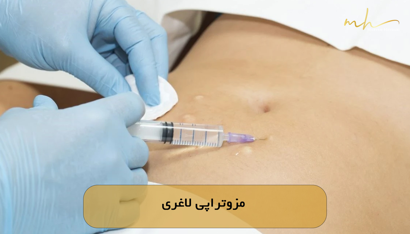 مزوتراپی لاغری