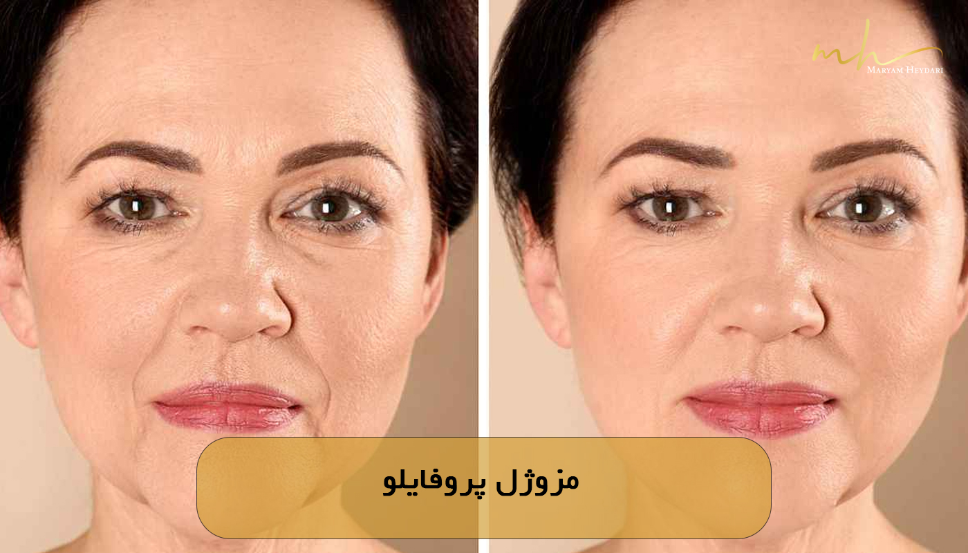 مزوژل پروفایلو