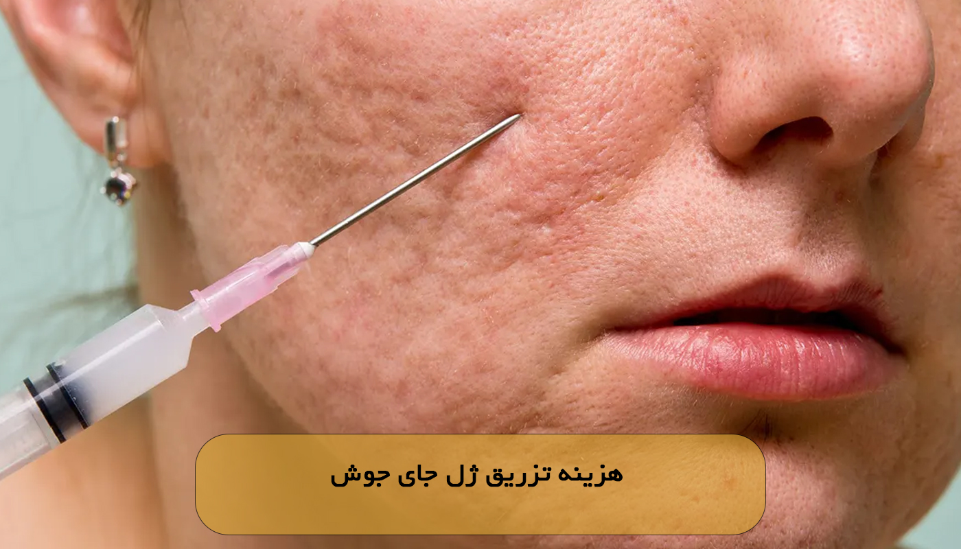 هزینه تزریق ژل جای جوش